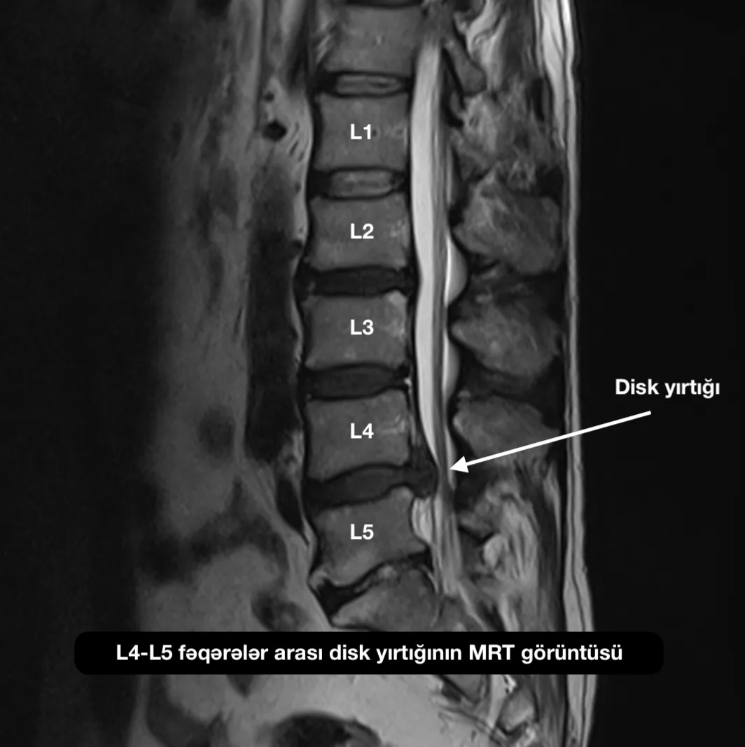 L4–L5 fəqərələri arası disk yırtığının MRT görüntüsü