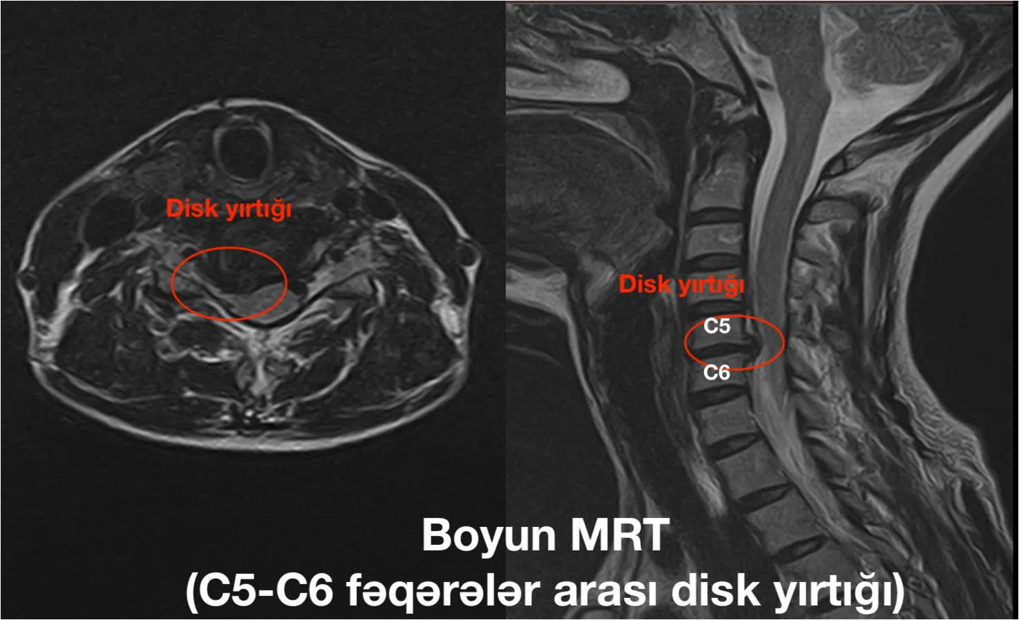 Boyun MRT: C5–C6 fəqərələri arası disk yırtığı
