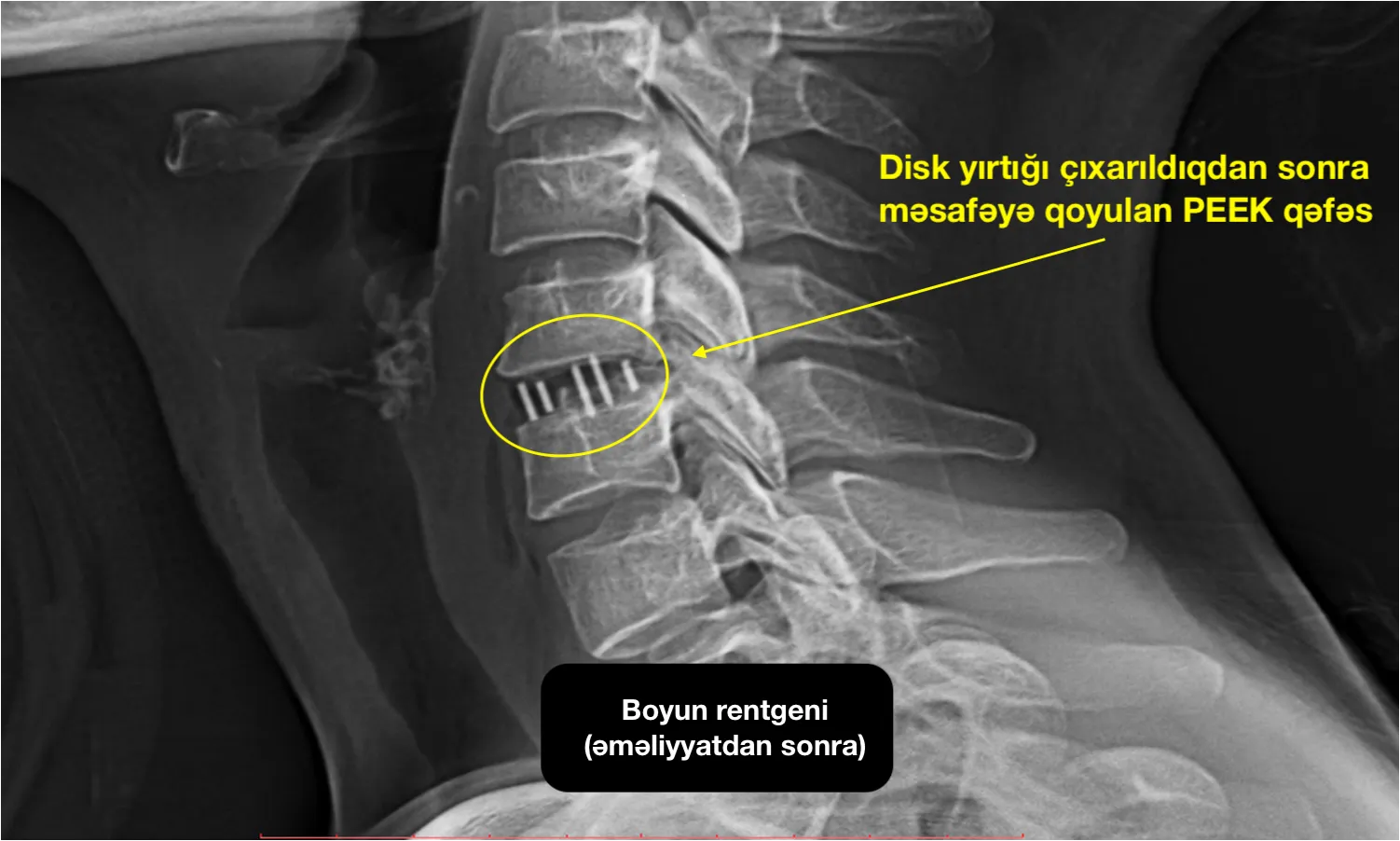 Boyun rentgeni: disk yırtığı çıxarıldıqdan sonra qoyulan PEEK qəfəs