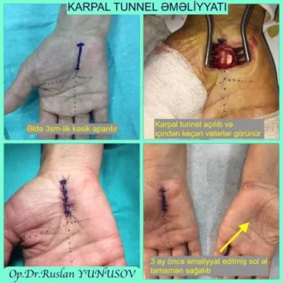 Karpal tunel əməliyyatının mərhələləri