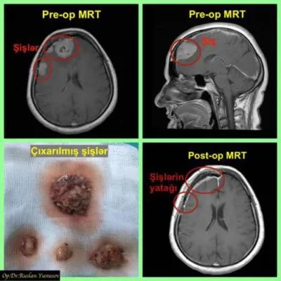 Əməliyyatdan əvvəl və sonra MRT, çıxarılmış dörd meningioma