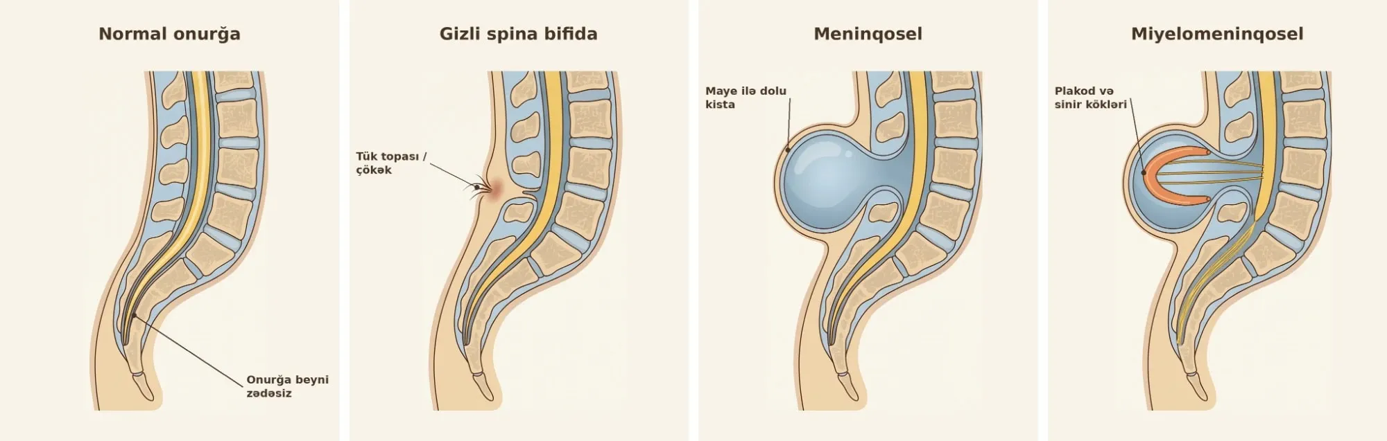 Normal onurğa, gizli spina bifida, meninqosel və miyelomeninqoselin yan kəsikdə müqayisəsi
